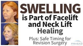 Why Swelling from Face and Neck Lifts Need to Resolve Before Revision and Advanced Healing Methods [upl. by Fisuoy212]