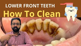 How to CLEAN Dirty Teeth at Home  Plaque Removal from Bottom Front Teeth [upl. by Anitnamaid]