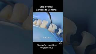 Teeth Composite bonding step by step [upl. by Lanita664]