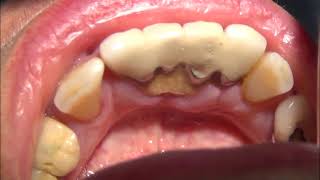 Ultrasonic Teeth Cleaning Cosmetic Dentistry Los Angeles  8187760055 [upl. by Zurn]