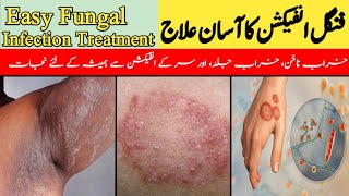 Fungal Infection Ka Asan Ilaj  Easy Fungal Infection Treatment  خراب ناخن کا علاج DrKashif Bilal [upl. by Dnartreb]