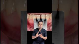 The secret to strong enamel revealed  Preventing enamel erosions expert tips delhidentist [upl. by Yeblehs]