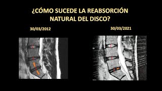 HERNIA DISCAL L5 S1  RECUPERA TU VIDA NORMAL REABSORCIÓN NATURAL DEL DISCO EXPLICADA EN DETALLE [upl. by Cyrilla]