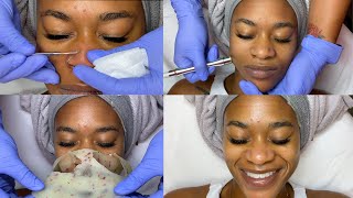 Double Exfoliation Facial w Microdermabrasion  GlamByLiaLeigh [upl. by Dnamron]