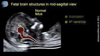 Open spina bifida at 1113 weeks gestation brainstem [upl. by Keyes261]