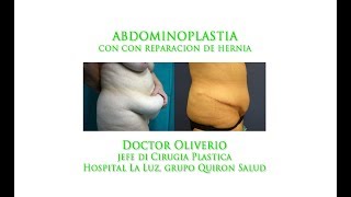 Abdominoplastia  Doctor Oliverio  Hospital La Luz grupo Quiron Salud [upl. by Aivull743]