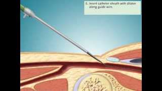 Cardiac Catheterization via Femoral Artery [upl. by Pritchett910]