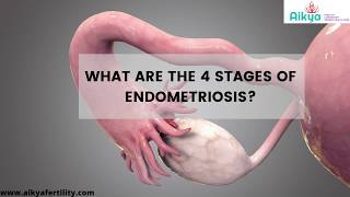 What are the 4 stages of Endometriosis  Endometriosis Treatment  Fertility Hospital in Bangalore [upl. by Nakashima]