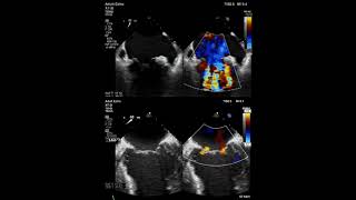 Mitral Regurgitation Mitraclip procedure [upl. by Harwin]