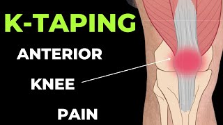 How to apply Kinesiology Tape for Anterior Knee  Patella tendonitis amp Patella femoral pain [upl. by Nortna]