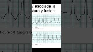 Criterios Morfológicos para Diagnosticar Taquicardias Bloqueo de Rama y Activación Ventricular [upl. by Inajar]