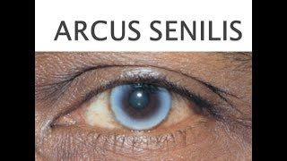 Arcus senilis  CHOLESTEROL RING  WHAT IS ARCUS SENILIS  TREATMENT OF WHITE SPOT IN THE EYE [upl. by Arihsak]