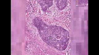 Histopathology Cervix Squamous cell carcinoma [upl. by Kathrine]