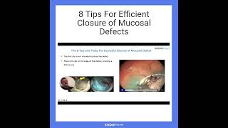 8 Tips For Efficient Closure of Mucosal Defects [upl. by Balfour]