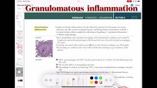 Granulomatous Inflammation Pathology 33  First Aid USMLE Step 1 in UrduHindi [upl. by Treva24]