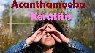 acanthamoeba keratitis English [upl. by Ecyt240]