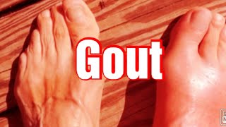 Gout Biochemistry  Types of Gout Treatment of Gout Hyperuricemia [upl. by Eimaj238]