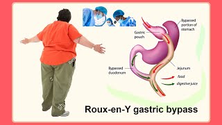 Roux en Y gastric bypass [upl. by Saint508]