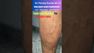 Foam Sclerotherapy treatment for varicose veins Varicose veins treatment before SSC GD medical [upl. by Roseann]