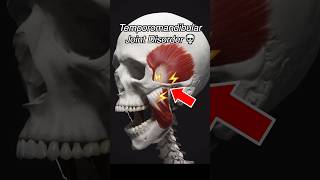 Temporomandibular Joint Dysfunction TMJ  TMD [upl. by Catima946]