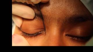 Lacrimal probing and syringing [upl. by Edson375]