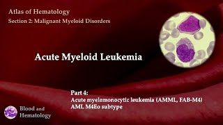 Acute Myeloid Leukemia AML  Part 4 [upl. by Bastian698]