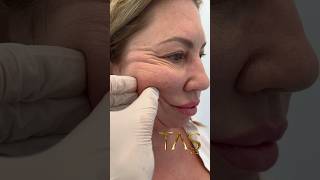 20 Years Back with Scarless Facelift by ProfDrSuleyman Tas facelift drsuleymantas [upl. by Obie]