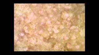 Scabies mites on skin crust [upl. by Radburn804]