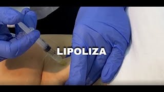 Lipoliza  Nehirurško uklanjanje masnih naslaga [upl. by Yeldar]