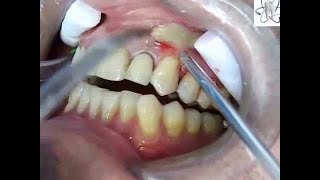 Abscess tooth removal  Tooth Abscess Extraction [upl. by Awahsoj977]