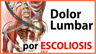 🛑 ¿CAUSAS del Dolor de espalda en la ESCOLIOSIS 👉 Ejercicio Clave  Objetivos en el TRATAMIENTO [upl. by Arodoet]