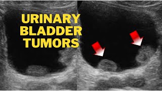 Ultrasound Video showing multiple Tumors in Urinary Bladder [upl. by Lhok]