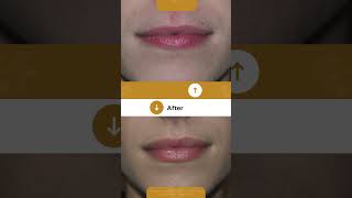 Get NaturalLooking Lip Fillers  Seattle WA [upl. by Halyk]