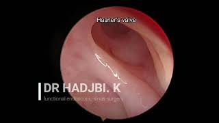 endoscopic view of Hasners valve  vue endoscopique de la valve de Hasner  canal lacrymonasal [upl. by Zile]