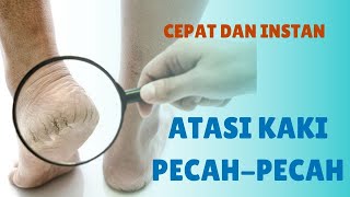 Telapak Kaki PecahPecah Cara Alami Ini Bisa Jadi Solusi [upl. by Anisah765]