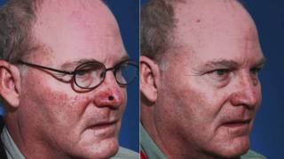 Nasal Reconstruction After MOHS Surgery [upl. by Lorrimer]