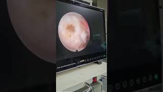 Endoscopic Spine Surgery PSLD Annuloplasty  Technique to reduce herniated rent site 6397887267 [upl. by Ahsyt]