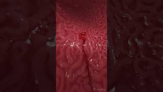 Bleeding gastric ulcer 3d animation anatomy meded [upl. by Annawak677]