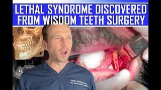 LETHAL SYNDROME DISCOVERED from WISDOM TEETH [upl. by Levi]