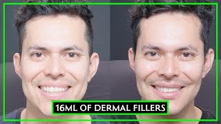 16 Syringes Of Dermal Filler Male MakeOver [upl. by Terpstra]