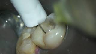 Caso clínico Dr Hipólito Fabra con limas de endodoncia Proclinic Expert [upl. by Cosenza773]