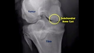 Facts about subchondral bone cyst  Usapang Pangkalusugan [upl. by Mikael]