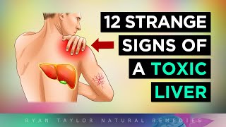 12 Strange Signs Your LIVER Is TOXIC [upl. by Arinaid]