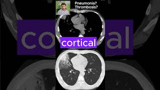 PNEUMONIA or pulmonary THROMBOSIS  CT SCANS Ep 8 medicalimaging ctscan pneumonia thrombosis [upl. by Dowell274]