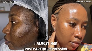 You won’t Believe This Happened to ME  POSTPARTUM SKIN  GLOWING 4 MONTHS LATER [upl. by Doomham]