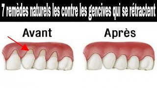 Les 7 remèdes naturels les plus efficaces contre les gencives qui se rétractent [upl. by Draned252]