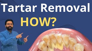 Tartar Removal from Teeth  Dental Teeth Cleaning [upl. by Gnurt]