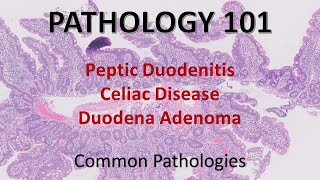 Peptic Duodenitis Celiac Disease Duodenal Adenoma  Pathology 101 GI Pathology [upl. by Anilatak]