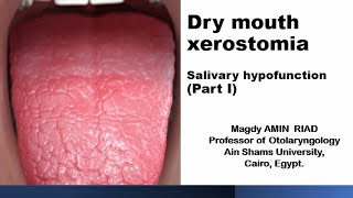 Dry mouth xerostomia Salivary hypofunction Part I [upl. by Lorac]