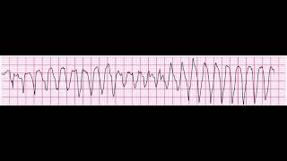 Torsades de Pointes 200bpm polymorphic ventricular tachycardia [upl. by Epperson]